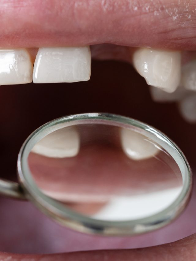 Losing teeth can lead to bone loss or bone resorption