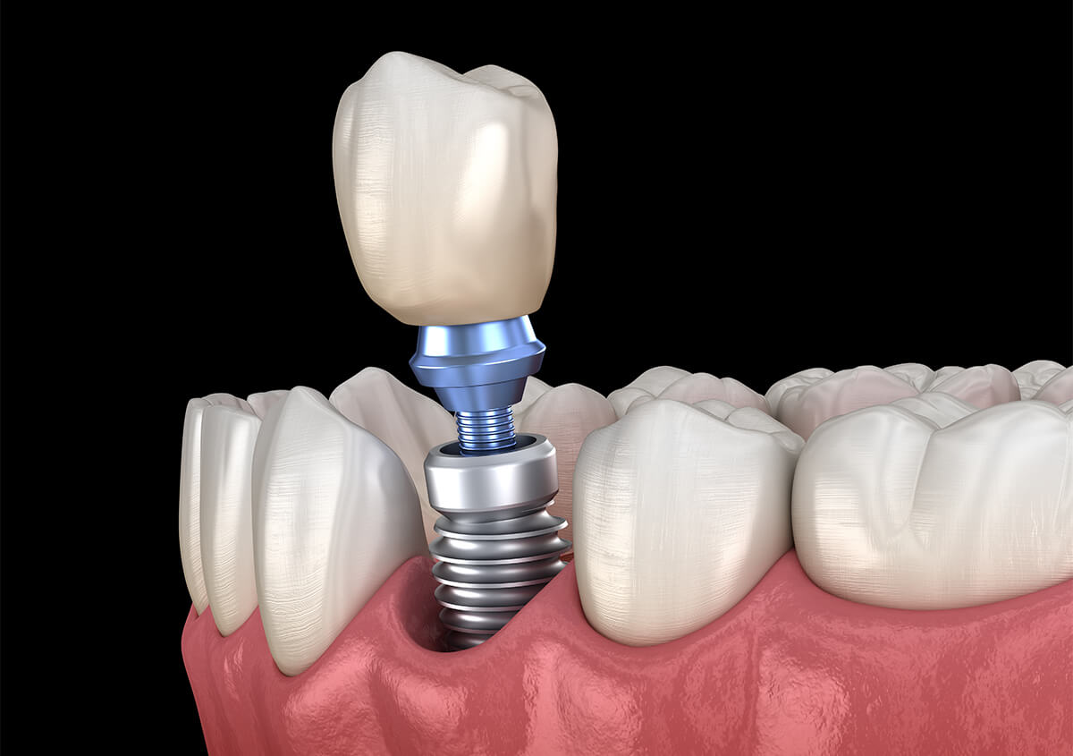 Cosmetic Dental Implants in Golden CO Area