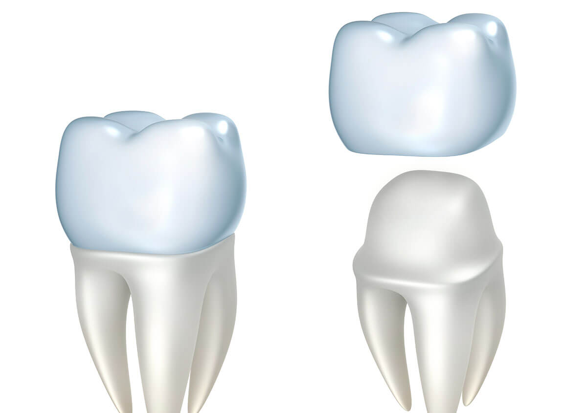 Tooth Crown Repair in Golden CO Area