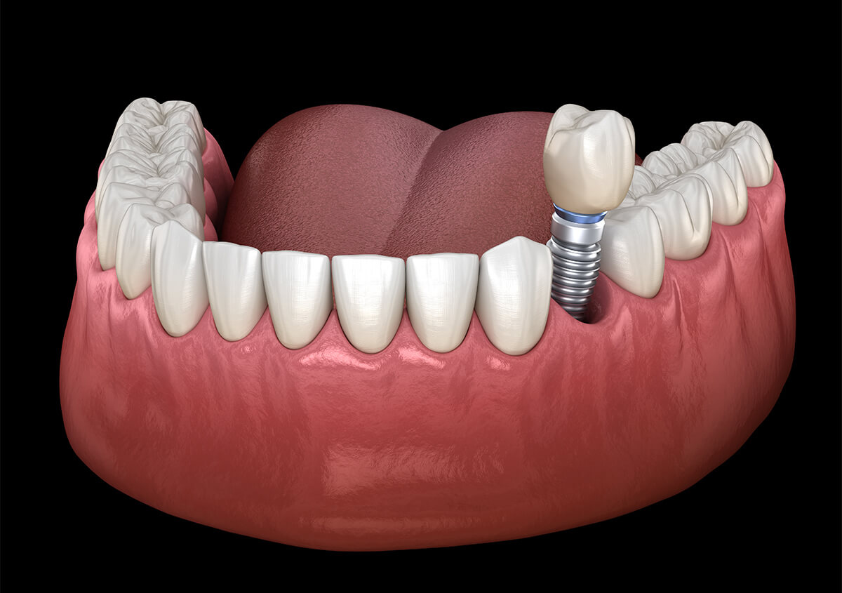 Implant Dentist in Golden Colorado Area
